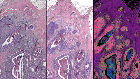 This side-by-side comparison of a breast tissue biopsy demonstrates some of the infrared-optical hybrid microscope’s capabilities. On the left, a tissue sample dyed by traditional methods. Center, a computed stain created from infrared-optical hybrid imaging. Right, tissue types identified with infrared data. The pink in this image signifies malignant cancer. Image courtesy of Rohit Bhargava