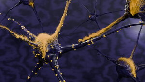 Computer-assisted image of aggregated plaques in neural areas