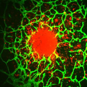 A green and red image showing how individual cells invade away from a central tumor spheroid and into the surrounding vascularized microenvironment. Tumor cells are shown in red and vasculature is shown in green.