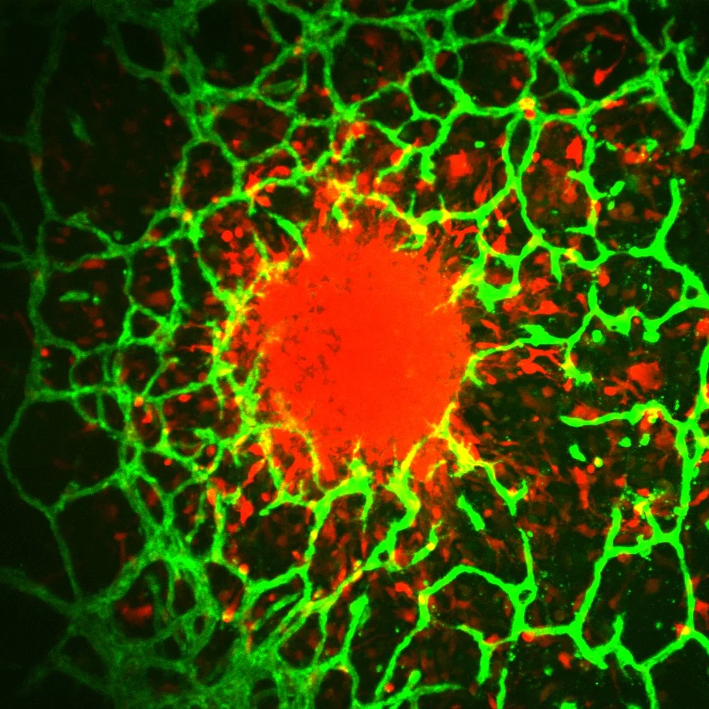 A green and red image showing how individual cells invade away from a central tumor spheroid and into the surrounding vascularized microenvironment. Tumor cells are shown in red and vasculature is shown in green.